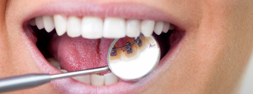 יישור שיניים חיצוני או פנימי